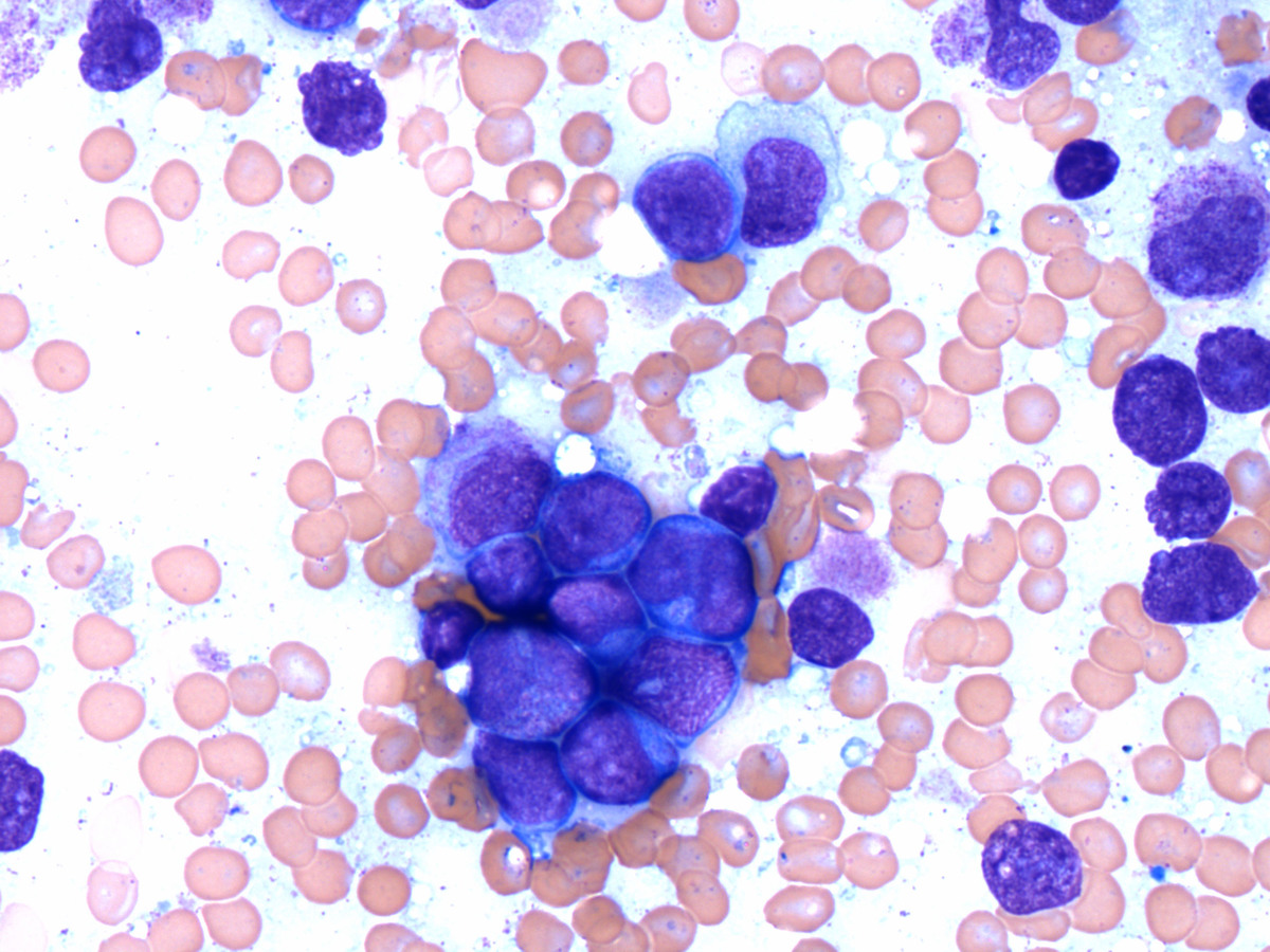 Bone marrow touch imprint shows that the blasts are medium to large in size with fine chromatin, prominent nucleoli, and scant to moderate amount of cytoplasm (Wright-Giemsa, 500x).